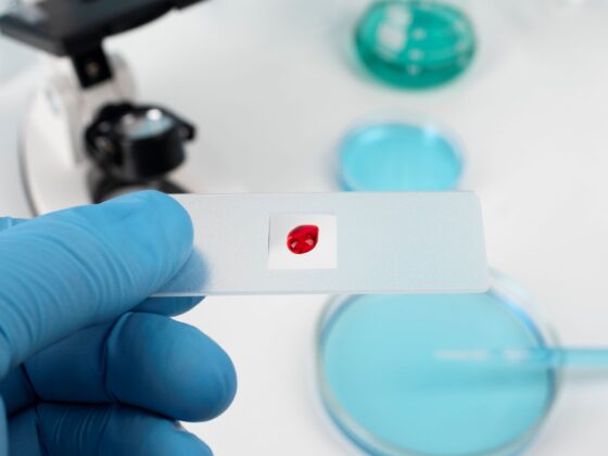 Anemia: teste de laborator folosite pentru analizele de sânge.
