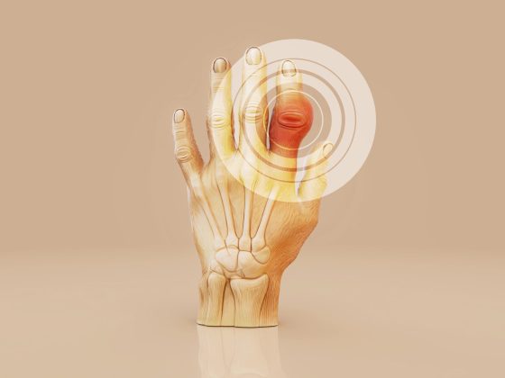 Prezentare medicală a inflamației articulațiilor degetelor, simptom timpuriu în poliartrita reumatoidă.