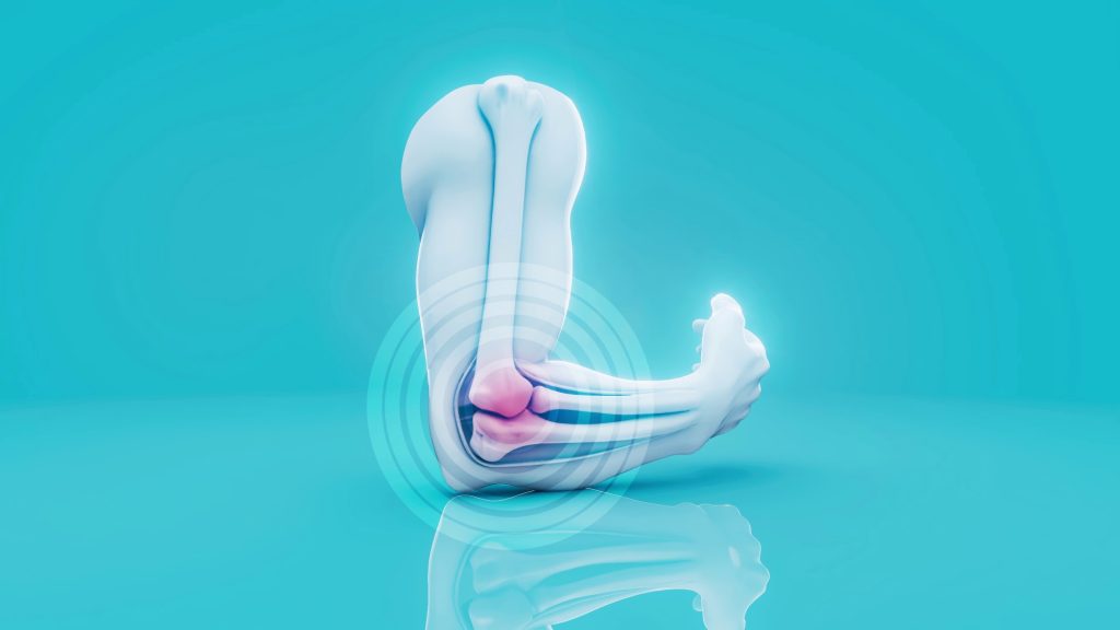 Epicondilita este o afecțiune frecventă cauzată de mișcări repetitive, nu doar de sport. Munca la birou poate fi un factor major.